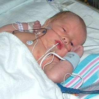 Birth Defects